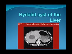Hydatid cyst of the liver