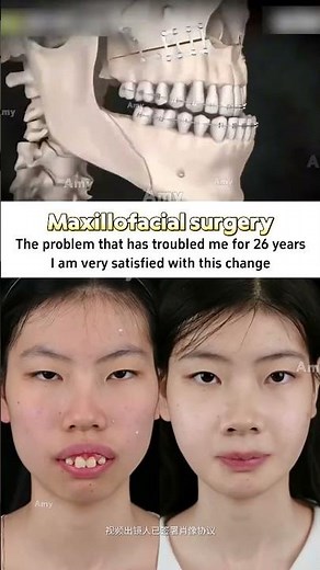 如果你也有这样的问题，欢迎来找我～ #plasticsurgery #facelifting #逆袭 #facelift #outline #jawsurgery #jawline #正颌 #do脸
