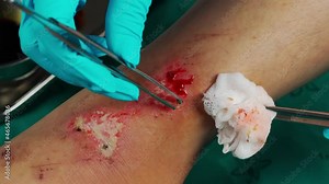 close up doctor cleaning wound on the leg by alcohol, Injuries from falling