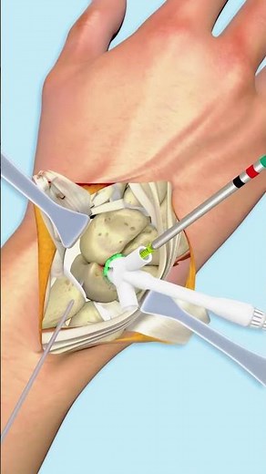 How Four Corner Fusion Surgery (3D Animation) #wristsurgery #medicalanimation #3danimation