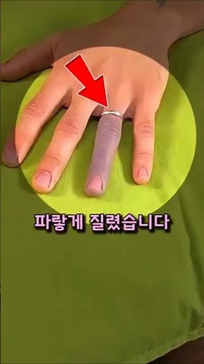 반지에 갇힌 손가락 구조법