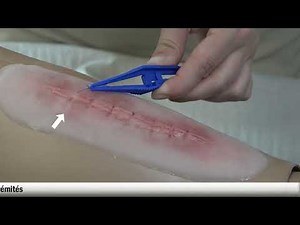 ceff SANTÉ-SOCIAL - Tutoriel - Ablation fils et agrafes