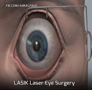 LASIK surgery used to correct vision in people who are nearsighted, farsighted, or have astigmatism. All laser vision correction surgeries work by reshaping the cornea, the clear front part of the eye, so that light traveling through it is properly focused onto the retina located in the back of the eye. | Aimal