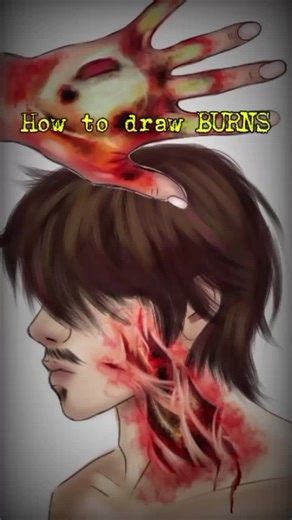 How to Draw Different Degrees of Burns