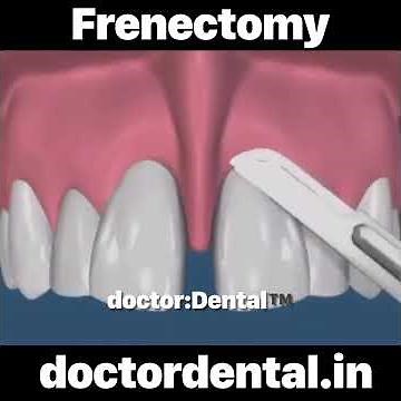 Frenectomy