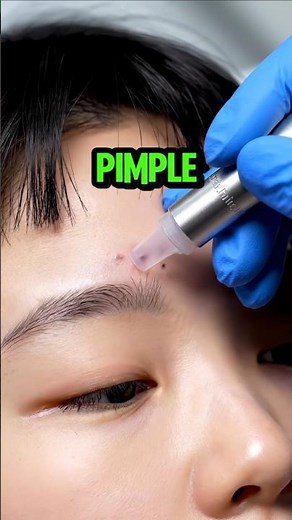 This Pimple Pop Was a HIDDEN BOMB Ready to EXPLODE!