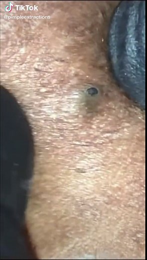pimpleextractions on TikTok