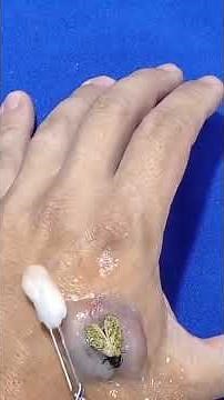 Botfly Maggot Removal