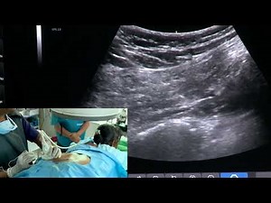 Ultrasound and C-arm guided intervention for Piriformis Syndrome