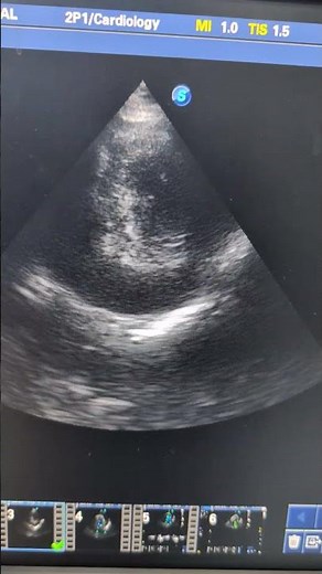 Cardiac Tamponade with Dilated IVC | Emergency Echocardiography Case | 2D Echo Findings🫀