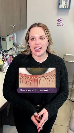 Itchy, Irritated Eyelids? You Might Have Blepharitis! 🚨