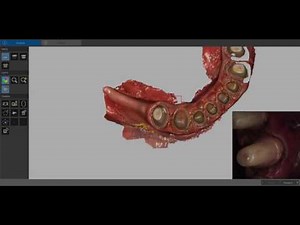Caresteram CS 3600 Preparation and capture intraoral scan / impression and retraction