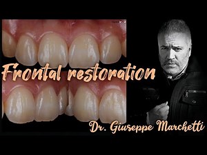 Frontal Composite Restoration Of Teeth • Video • MEDtube.net