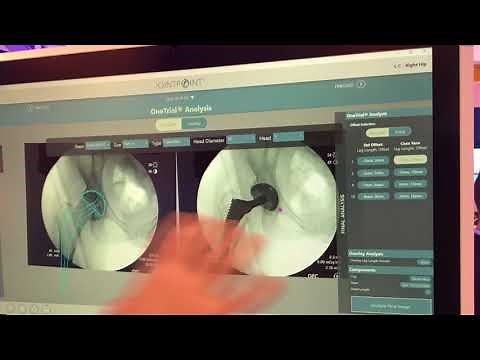 Digital Surgery Solutions: JointPoint Software Platform for Hip Surgery