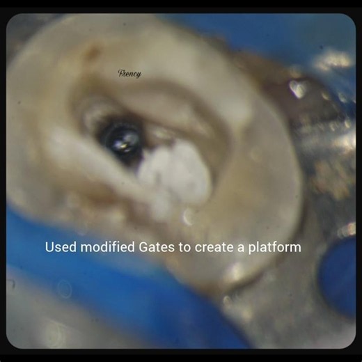 Bypassing a separated file#bypassing#rerct #endo #rootcanal
