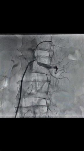 𝐑𝐞𝐧𝐚𝐥 𝐚𝐫𝐭𝐞𝐫𝐲 𝐚𝐧𝐠𝐢𝐨𝐩𝐥𝐚𝐬𝐭𝐲 Step by step @ cardiac intervention lover For educational purpose only | Practical Interventional Cardiology