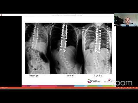 Surgical correction of Idiopathic Scoliosis