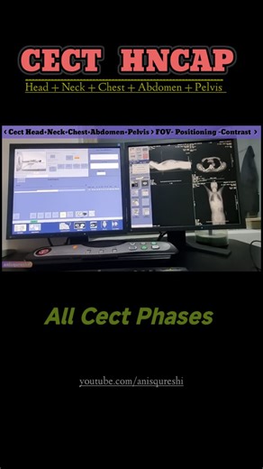 CECT Protocol from Head to Pelvis — Timing, Contrast & Phases Explained! Perfect guide for radiology students. In this reel, I’ve explained the Complete CECT (Contrast-Enhanced CT) Protocol for Head, Neck, Chest, Abdomen & Pelvis, covering all essential steps used in routine practice: 🔹 Topo (A.P & Lateral) – Proper planning of scan range & patient positioning 🔹 NCCT (Non-Contrast Phase) – Baseline evaluation for bleed, stones, calcifications, hyperdensities 🔹 Contrast Administration Protocol