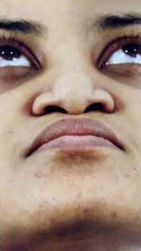 Buried NOSE Resurrected - Reconstructive Rhinoplasty in India