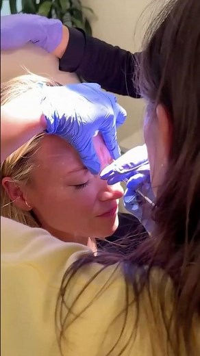 Professional Botox® Technique: The Withdrawal Method You Need to Know 💉