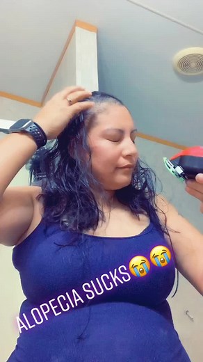 Shaving My Head and Embracing Alopecia Journey