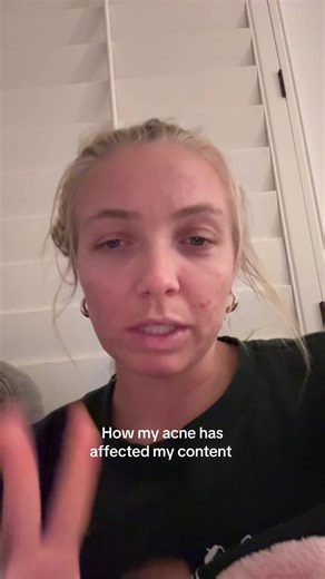 Embracing Authenticity: My Acne Journey on Camera