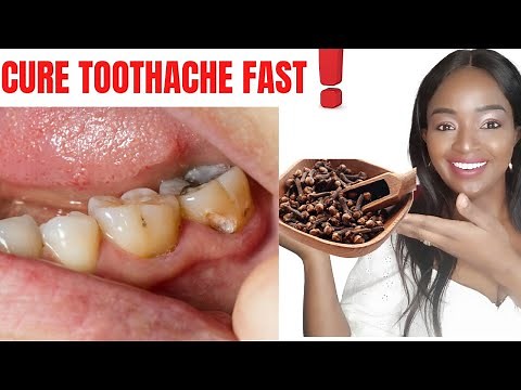 HOW TO INSTANTLY STOP A TOOTHACHE AT HOME REMEDY||Clove oil for Toothache#cloves