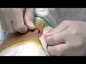 Top 3 Forgotten Pops! Dr. Gilmore's Best, Lost Cysts & Growths!