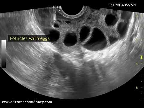 Egg retrieval surgery / OPU (Ovum pickup) / IVF #ivf #infertility #dr.ranachoudhary #testtubebaby