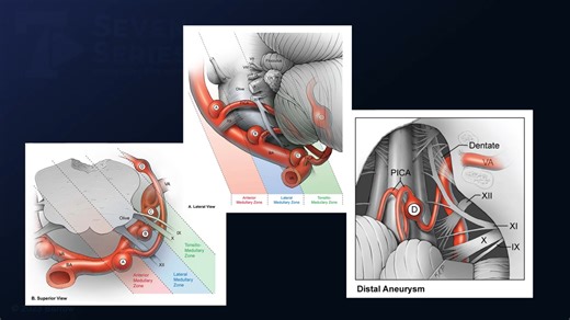 #187: Suboccipital Craniotomy for Clipping of Ruptured Distal Posterior Inferior Cerebellar Artery Aneurysms - Aneurysm - Seven Series Collection
