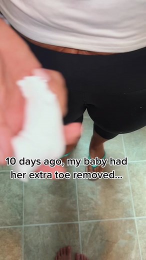 We love you little lobster claw ❤️ #polydactyl #11toes #lobsterclaw #surgerytiktok #polydactyly #castremoval #footreveal #storytime #fyp #babiesoftiktok #momsoftiktok #polydactylybaby #babytoes #fypシ