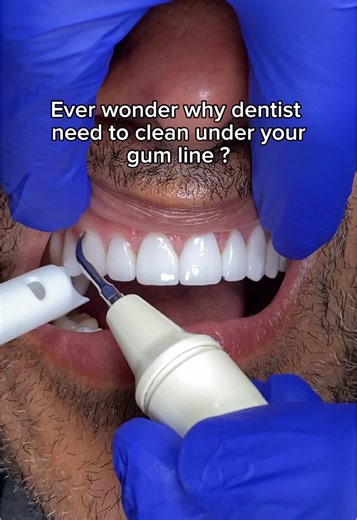 Deep Cleaning Techniques for Porcelain Veneers