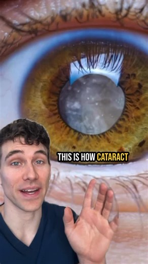 Joseph Allen, OD, FAAO, Dipl ABO on Instagram: "Cataract surgery is one of the most common and successful eye procedures in the world. In this video, Dr. Allen explains how surgeons remove the cloudy natural lens using ultrasound or laser, then replace it with a clear intraocular lens (IOL). This new lens not only helps you see more clearly, but can often reduce your need for glasses too! This video details how a surgeon performs a modern cataract surgery, a common procedure to address vision im
