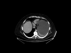 Gastric outlet obstruction