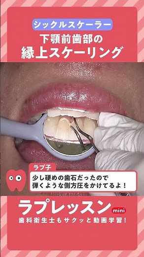 【ラプレッスンmini】症例で見る！下顎前歯部の縁上スケーリング