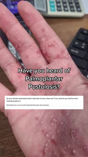 Zoe's journey through palmoplantar pustulosis hasn't been easy. It’s a rare auto immune skin condition where blisters and pus-filled bumps, known as pustules, appear on the palms of the hands and the soles of the feet. #fyp #palmoplantarpustulosis #skinconditions #sensitiveskin #yoursonly #dramaticskin