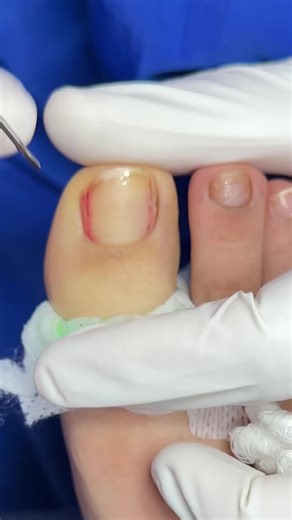 Matricectomia química, solución definitiva para uñas incarnada a #matricectomia #podologo #podologia #pies #uñeros #uñaenterrada