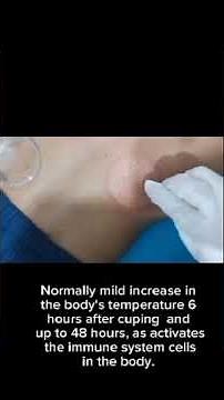 Cupping Therapy how to perform