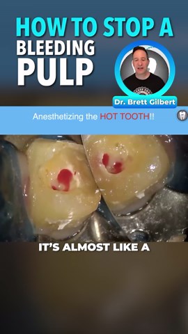 A healthy pulp looks like gray gelatin—soft and intact. An inflamed pulp? Fire-engine red, irritated, and ready to bleed. If bleeding won’t stop, check for hidden tissue under pulp horns. Opening them up can make all the difference.🔥 @drbrettgilbert is a mentor in our "Access Endo" course. WANT TO LEARN MORE? Comment ENDO and I'll send you our Access Endo FREE training! #dentist #newdentist #endo #endodontist #endotraining #accessendo #dentalpracticemastery #dentalirrigation #endodontics #endod