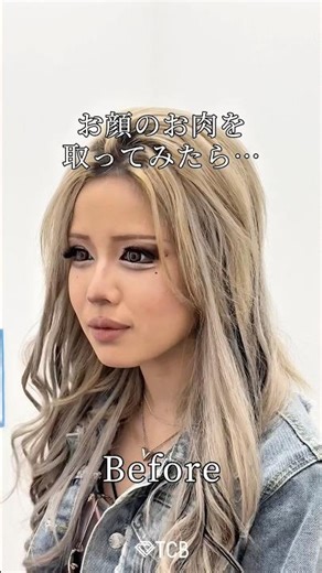 【脂肪吸引・糸リフト】お顔のお肉を取ってみたら… #shorts