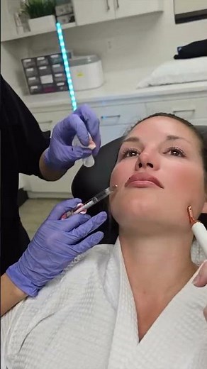 Juvederm Lip Filler Treatment Procedure | Step-by-Step Natural Lip Enhancement at CMA Miami 💋✨