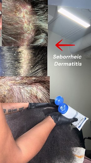 Understanding Scalp Psoriasis vs. Seborrheic Dermatitis