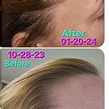 Vital Hair Complex – Biotin & Vitamin B Hair Vitamins for Women & Men – Supports Healthy Hair, Skin & Nails – Hormone-Free, Gluten-Free – Hair Supplement for Women & Men