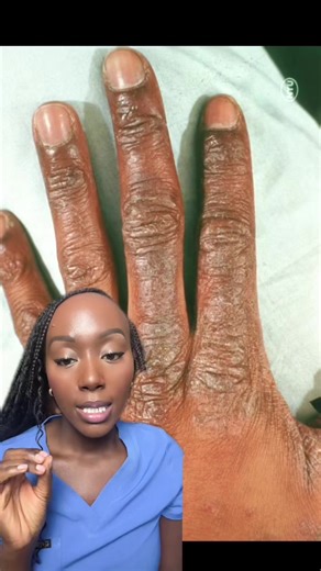 Effective Tips to Relieve Dry, Irritable Hands in Winter