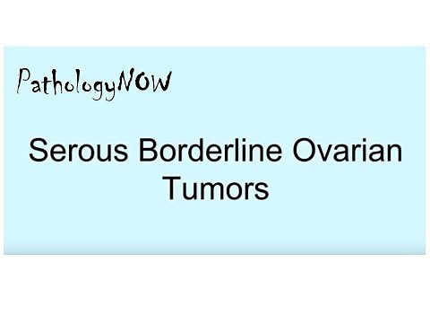 Pathology of Serous Borderline Ovarian Tumors