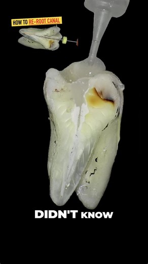 Effective EDTA Protocol for Calcium Hydroxide Removal