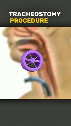 131K views · 1.2K reactions | Tracheostomy procedure with Royalty song. #tracheostomy #medicaleducation #LearnOnTikTok #healtheducation #healthcaretips | Surgery Page | Facebook