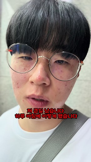 편평 사마귀 제거 후기와 관리법