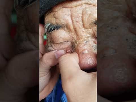 Màn nặn mụn 100 tuổi | blackheads removal 100-year-old @@(Part 1)