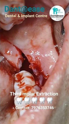 Painless wisdom tooth extraction #dentalartistry #oralhealth #dentist